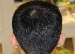 -大麦微针植发丨全国连锁