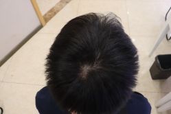 -大麦微针植发丨全国连锁