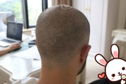 -大麦微针植发丨全国连锁