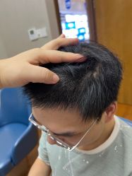 体验后-大麦微针植发全国连锁