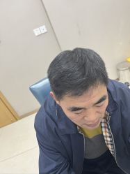 体验后-大麦微针植发丨全国连锁