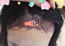 -大麦微针植发全国连锁