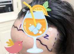 -大麦微针植发全国连锁