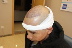 -大麦微针植发丨全国连锁