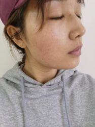 体验后-北京爱育华医院-医疗美容科