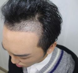 -大麦微针植发丨全国连锁