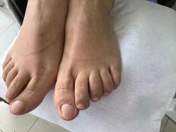 -德哥灰指甲脚气甲沟炎跖疣护理