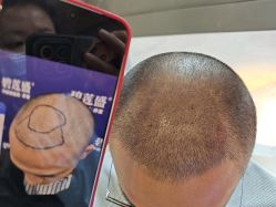 -碧莲盛·不剃发植发