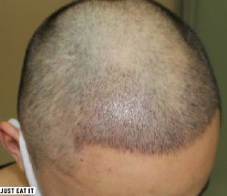 -大麦微针植发丨全国连锁