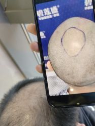 -碧莲盛·不剃发植发