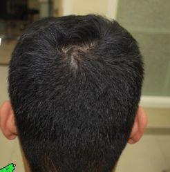 -大麦微针植发丨全国连锁