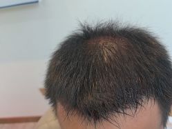 -碧莲盛·不剃发植发
