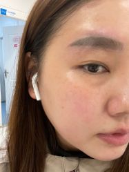 体验后-郡艺医疗美容·微整·眼鼻吸脂