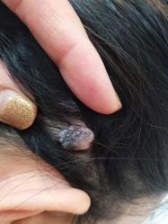 -北京美痣堂古方祛痣斑疣瘊