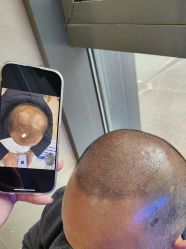 -碧莲盛·不剃发植发