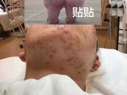 -塑青春&伊肤泉祛痘皮肤管理
