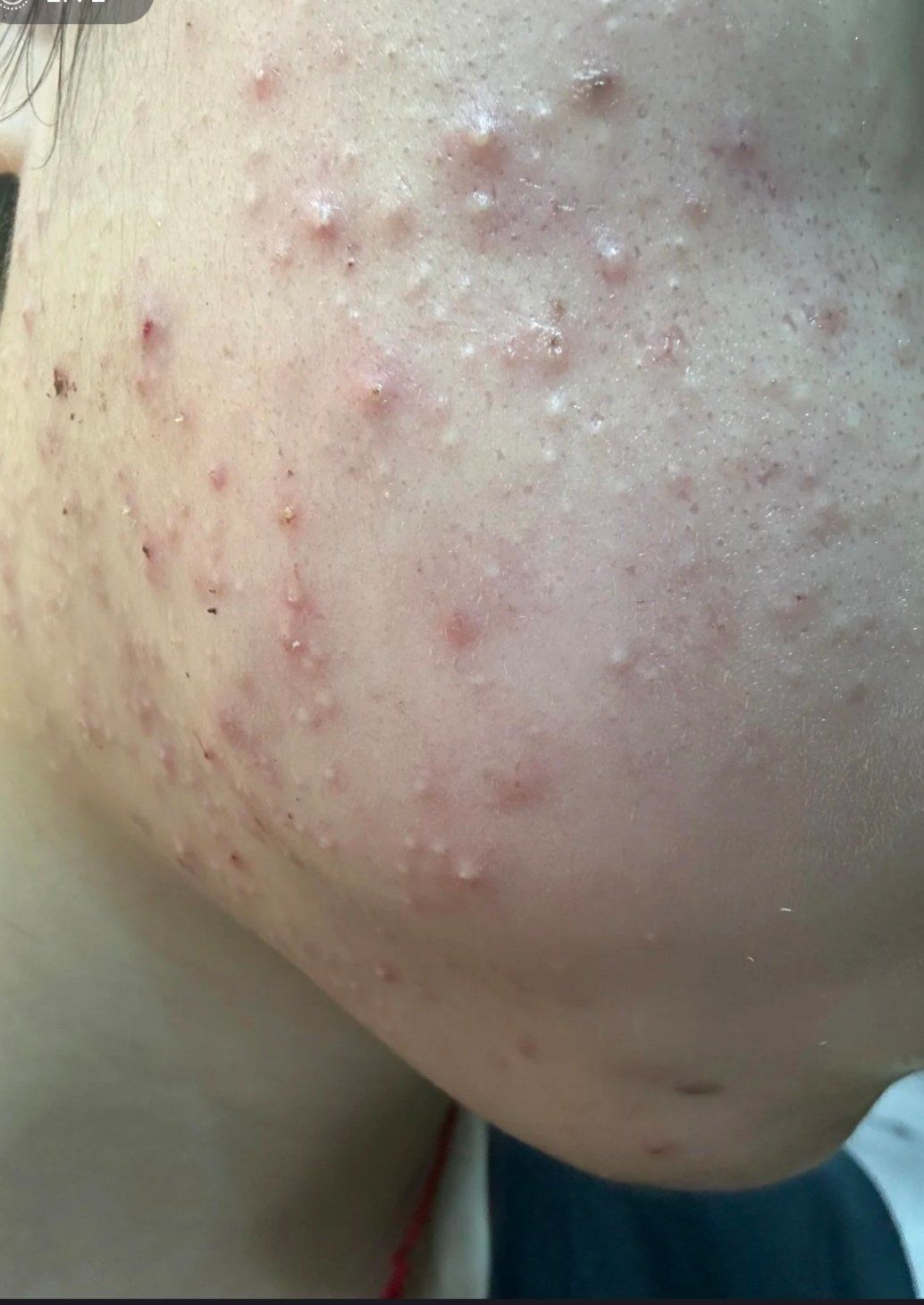 毛孔重度堵塞,因为有了闭口没有及时护理