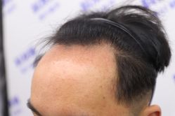 -大麦微针植发丨全国连锁