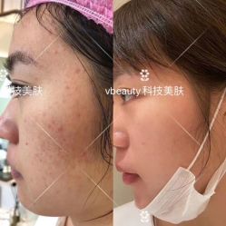 -苑苑vbeauty科技美容SPA