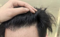 -大麦微针植发丨全国连锁