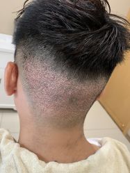 -大麦微针植发丨全国连锁