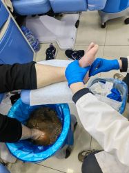 -德哥灰指甲脚气甲沟炎跖疣护理