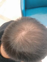 -碧莲盛·不剃发植发