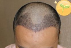 -大麦微针植发丨全国连锁