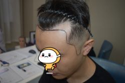 -大麦微针植发全国连锁