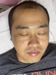 体验前-苗方清颜专业祛痘