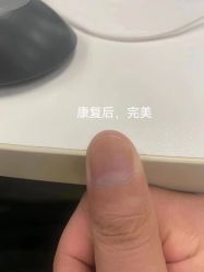 -德哥灰指甲脚气甲沟炎跖疣护理