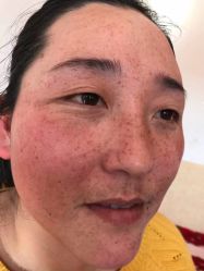 -爱莎扁平疣·汗管瘤·斑痣中心