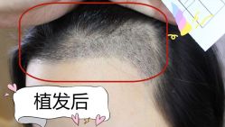 -大麦微针植发全国连锁