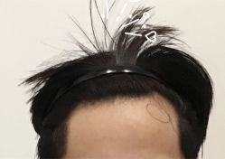 -大麦微针植发全国连锁