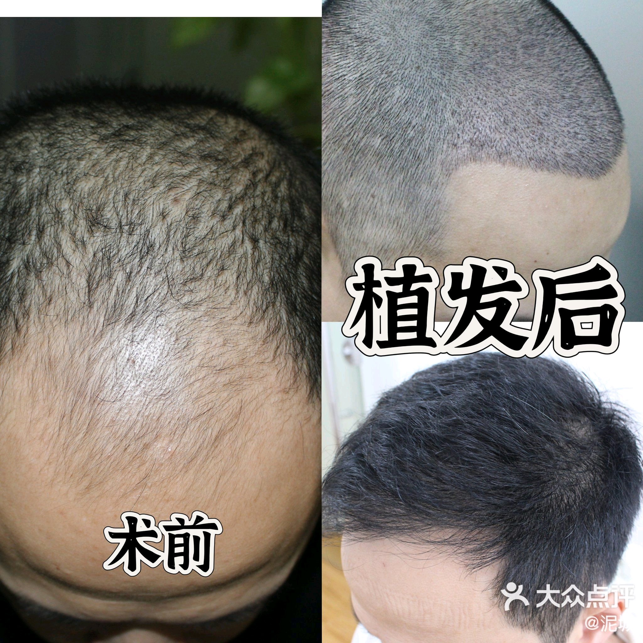 真微针植发(真微针植发和假微针植发区别)