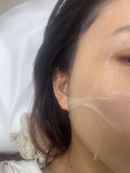 体验后-深圳春天阳光医院·轮廓抗衰中心