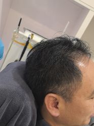 -大麦微针植发丨全国连锁