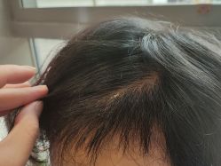 -碧莲盛·不剃发植发