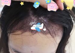 -大麦微针植发全国连锁