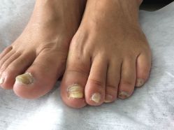 -德哥灰指甲脚气甲沟炎跖疣护理