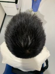 -大麦微针植发全国连锁