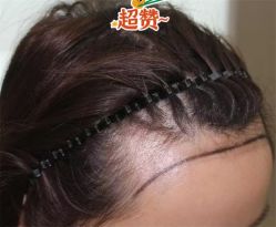 -大麦微针植发全国连锁