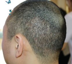 -大麦微针植发丨全国连锁