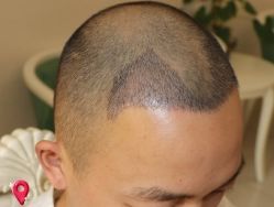 -大麦微针植发丨全国连锁