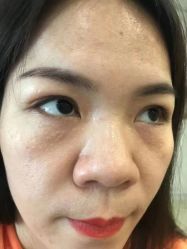 体验前-爱莎扁平疣·汗管瘤·斑痣中心