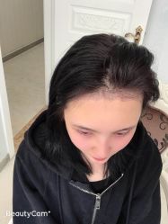 -大麦微针植发丨全国连锁