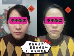 体验后-洁铭新加坡医美