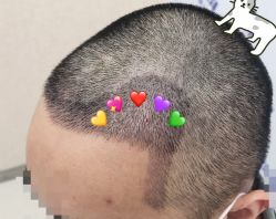 -大麦微针植发全国连锁