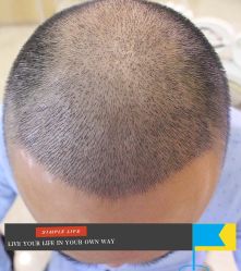 -大麦微针植发丨全国连锁