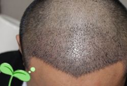 -大麦微针植发丨全国连锁